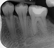 External cervical resorption - Pre-op X-ray case 1